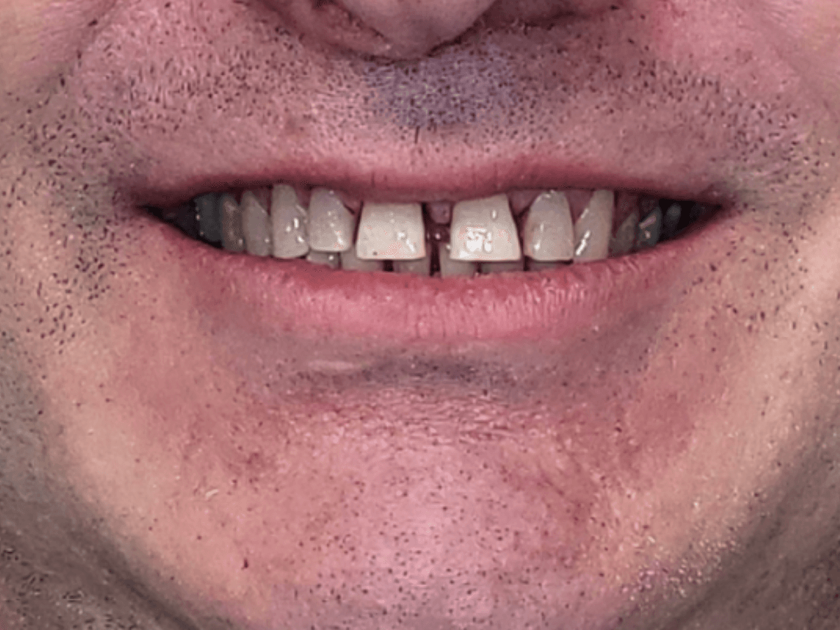 Antes de Carillas cerámicas - Dra. Laura Delgado Neuquén