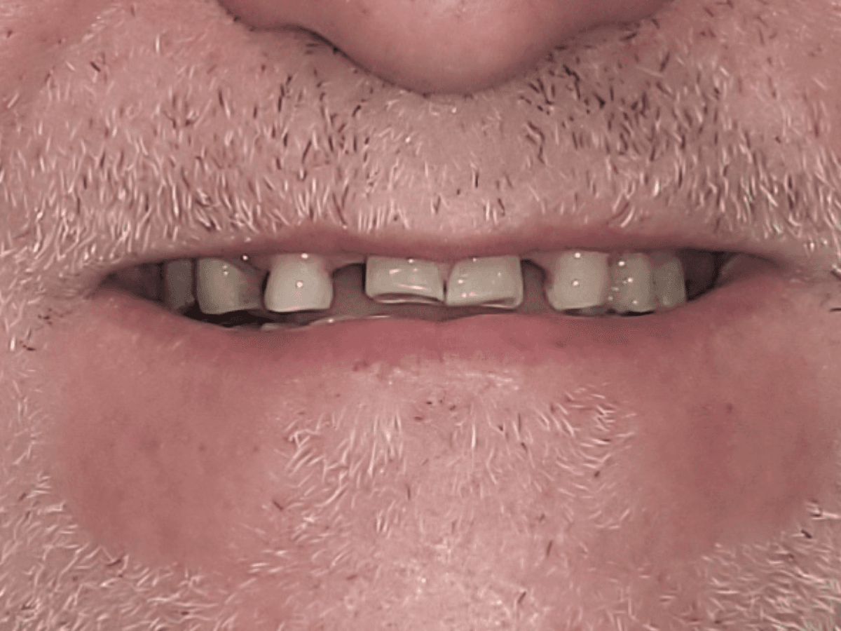 Antes de Rehabilitación total - Dra. Laura Delgado Neuquén