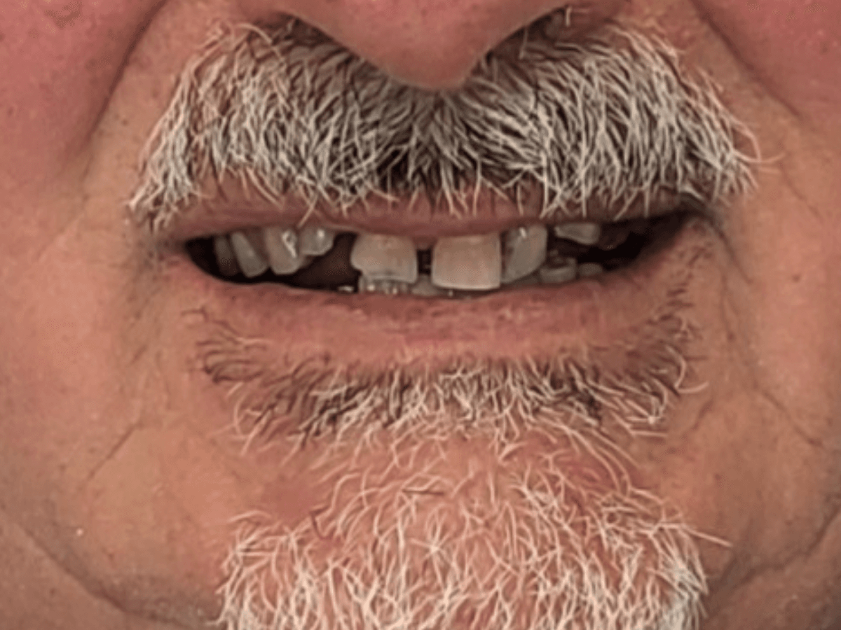 Antes de Rehabilitación implantosoportada - Dra. Laura Delgado Neuquén