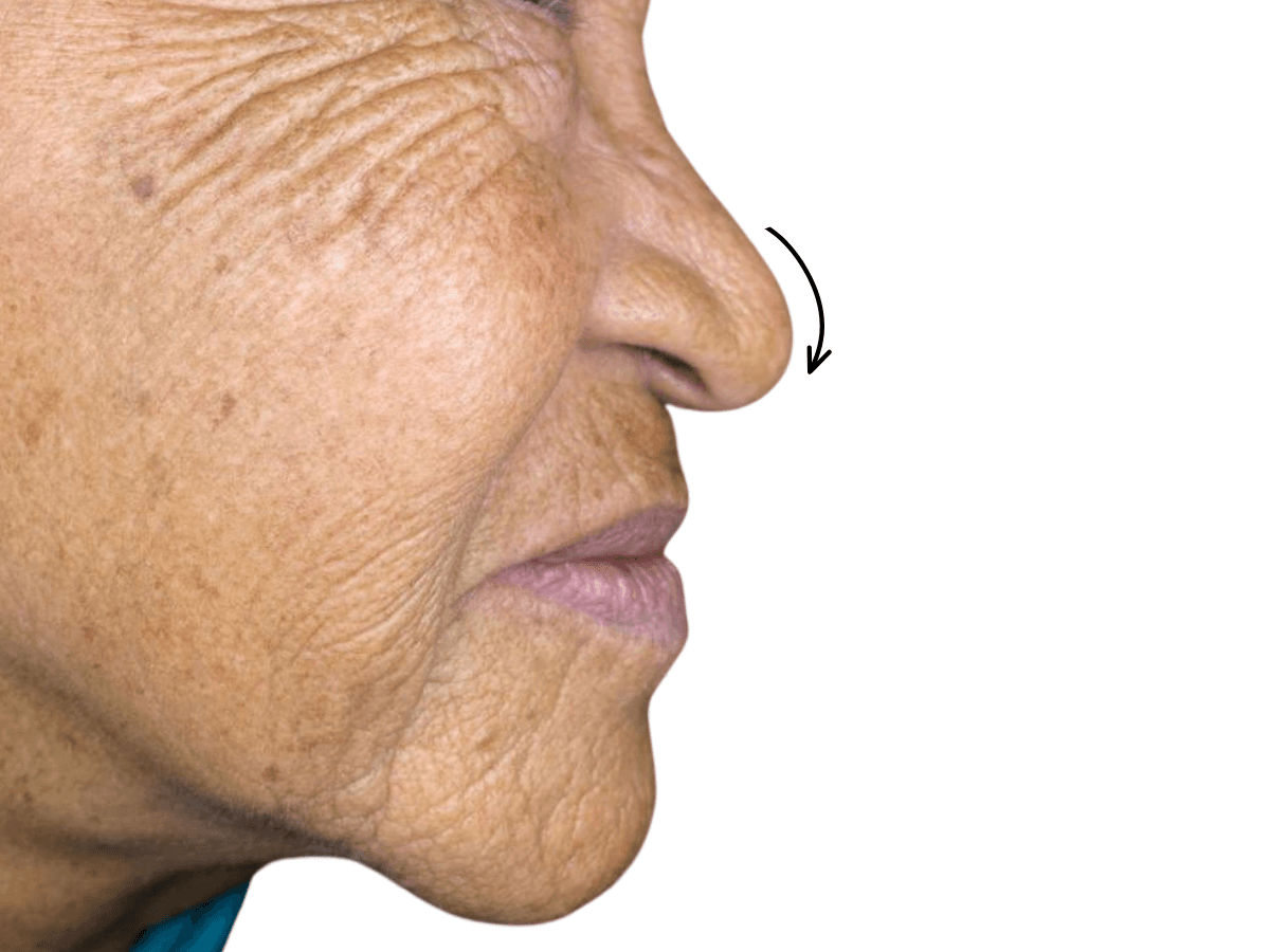 Antes de Rinomodelación - Dra. Laura Delgado Neuquén