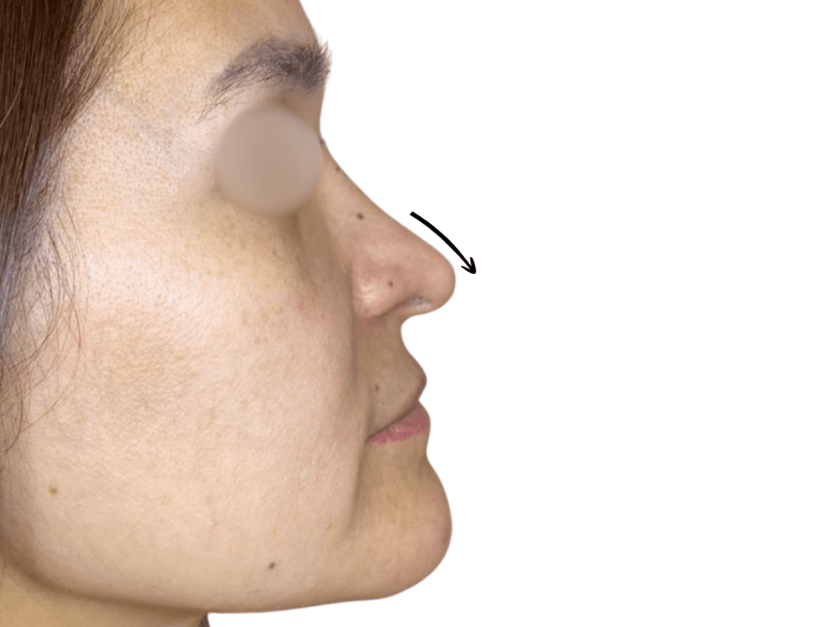 Antes de Rino y perfilado natural de labios - Dra. Laura Delgado Neuquén