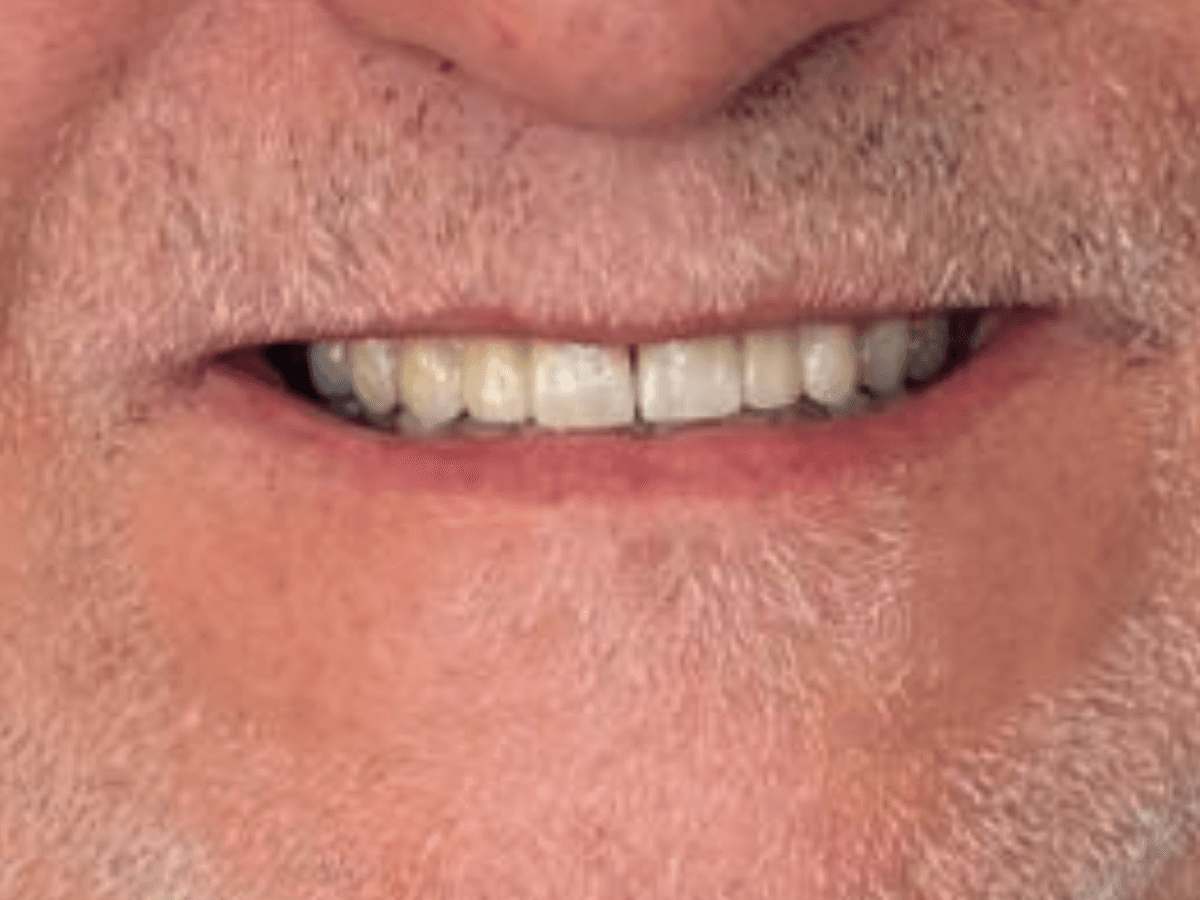 Resultado después de Rehabilitación total - Dra. Laura Delgado Neuquén