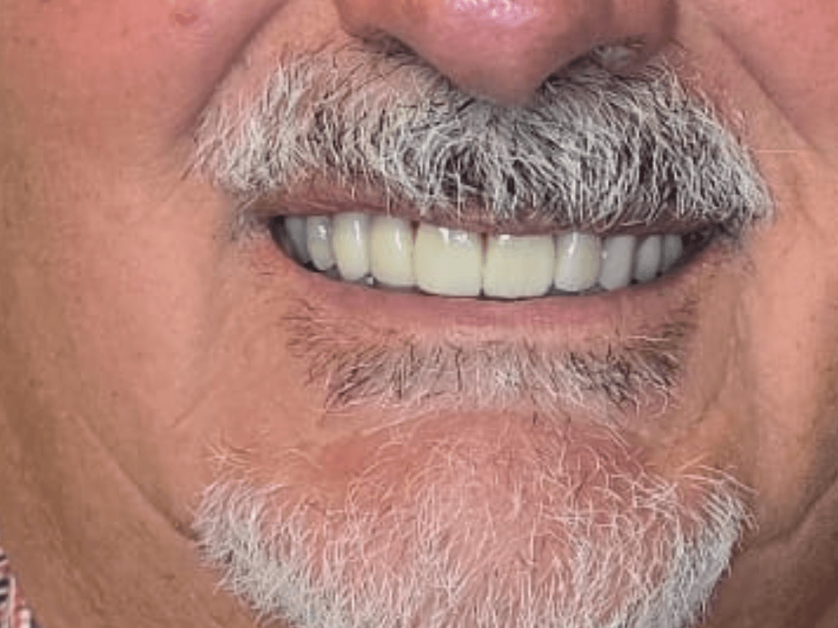 Resultado después de Rehabilitación implantosoportada - Dra. Laura Delgado Neuquén