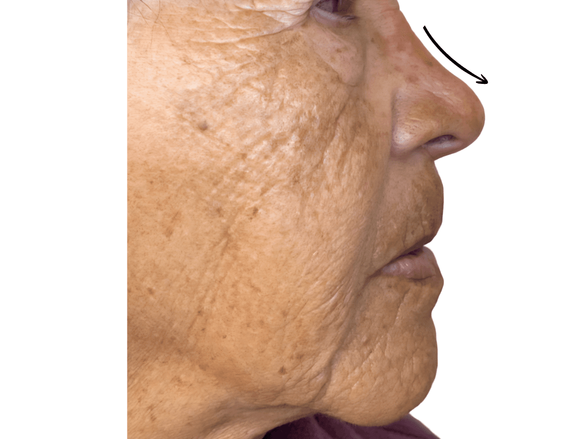 Resultado después de Rinomodelación - Dra. Laura Delgado Neuquén